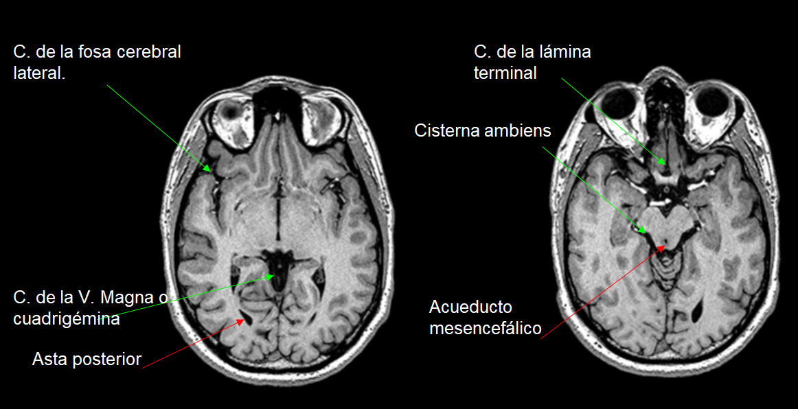 Preventiva